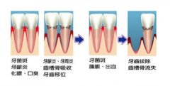 牙周炎该怎么诊疗